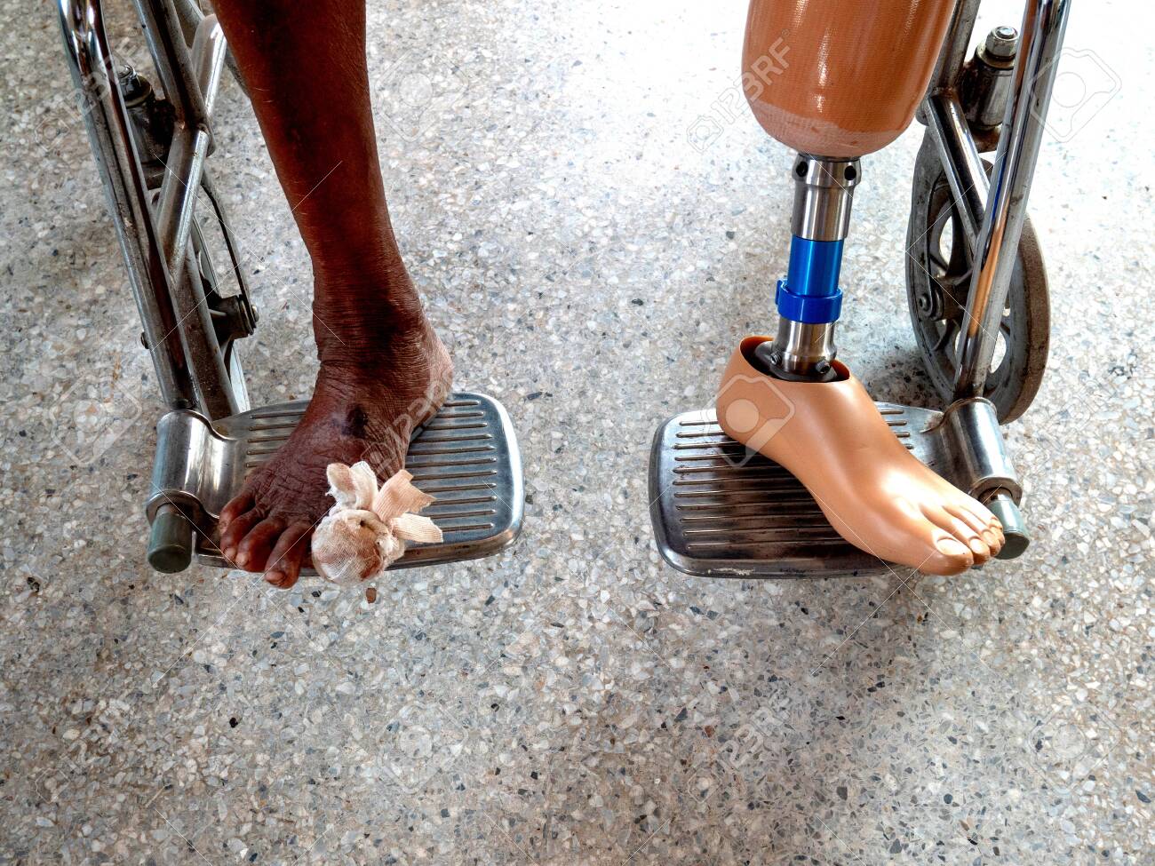 amputated left leg with leg prosthesis